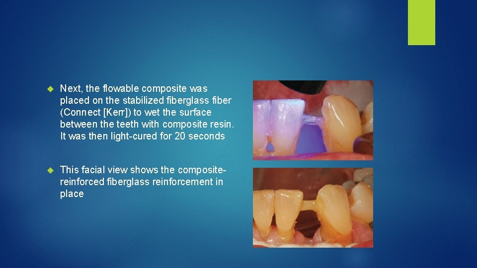  Next, the flowable composite was placed on the stabilized fiberglass fiber (Connect [Kerr])