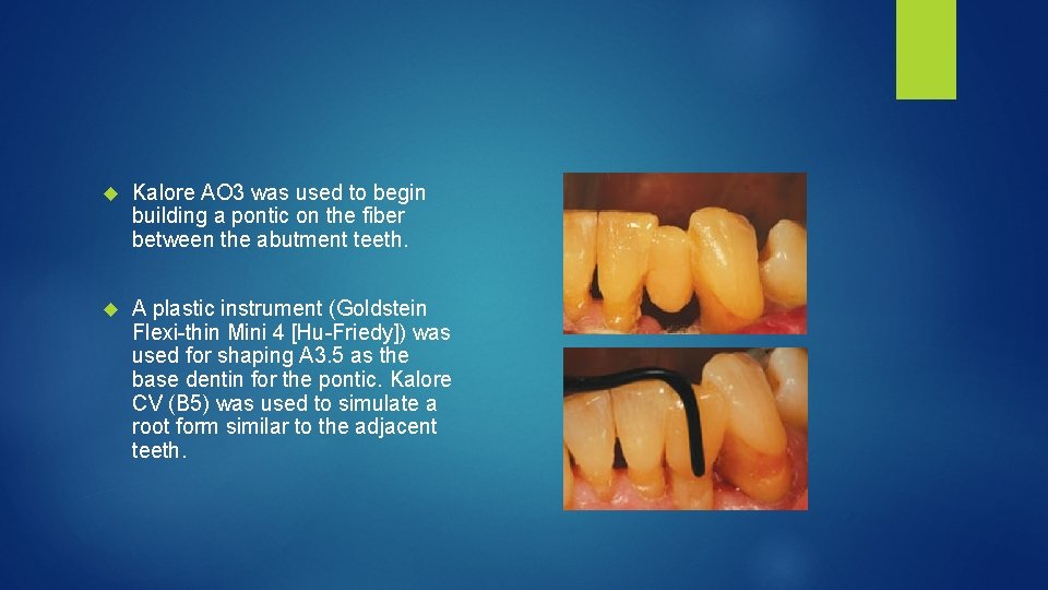  Kalore AO 3 was used to begin building a pontic on the fiber