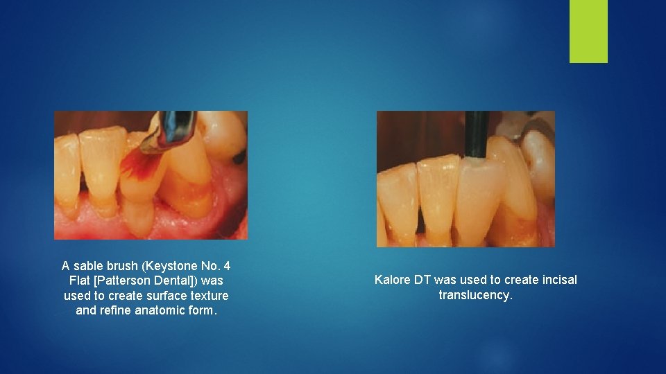 A sable brush (Keystone No. 4 Flat [Patterson Dental]) was used to create surface