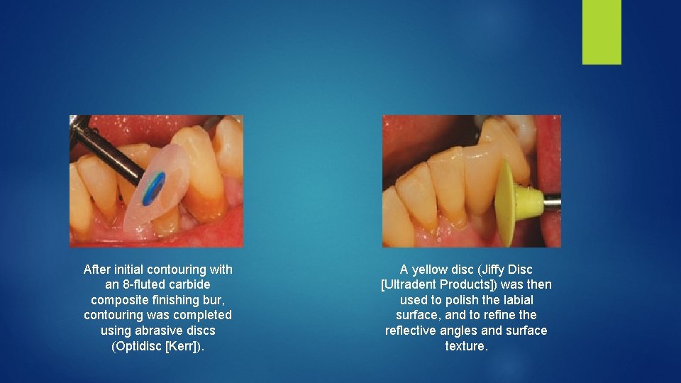 After initial contouring with an 8 fluted carbide composite finishing bur, contouring was completed