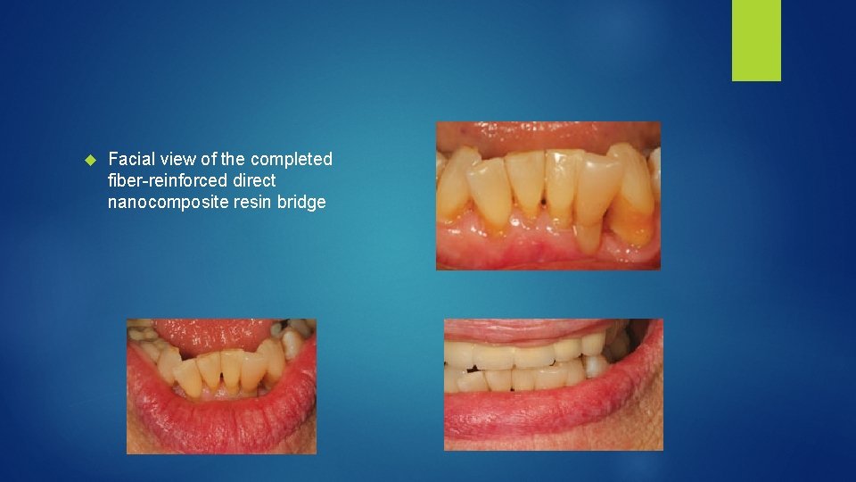  Facial view of the completed fiber reinforced direct nanocomposite resin bridge 