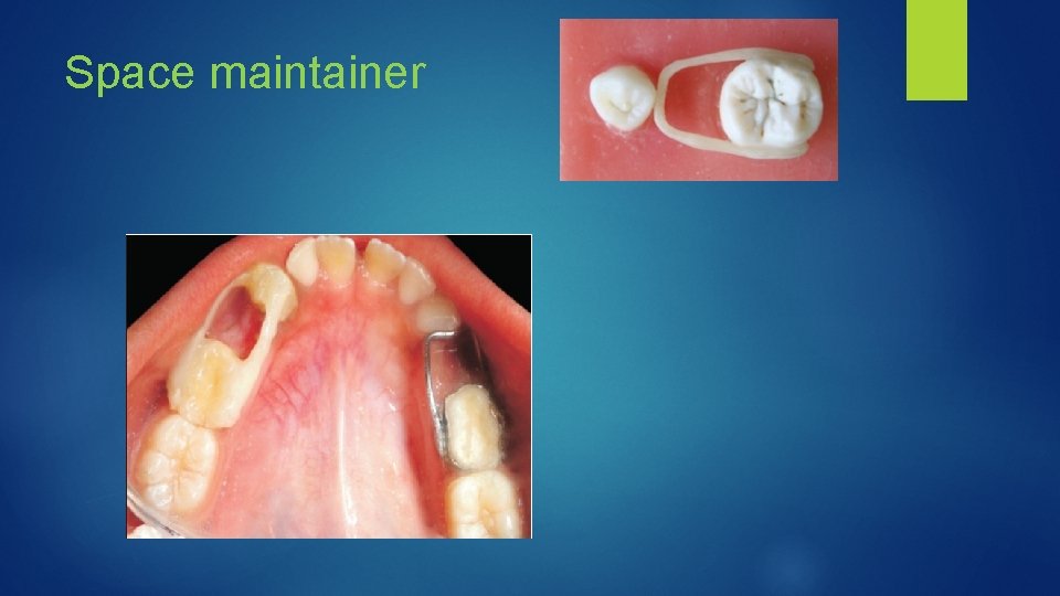 Space maintainer 