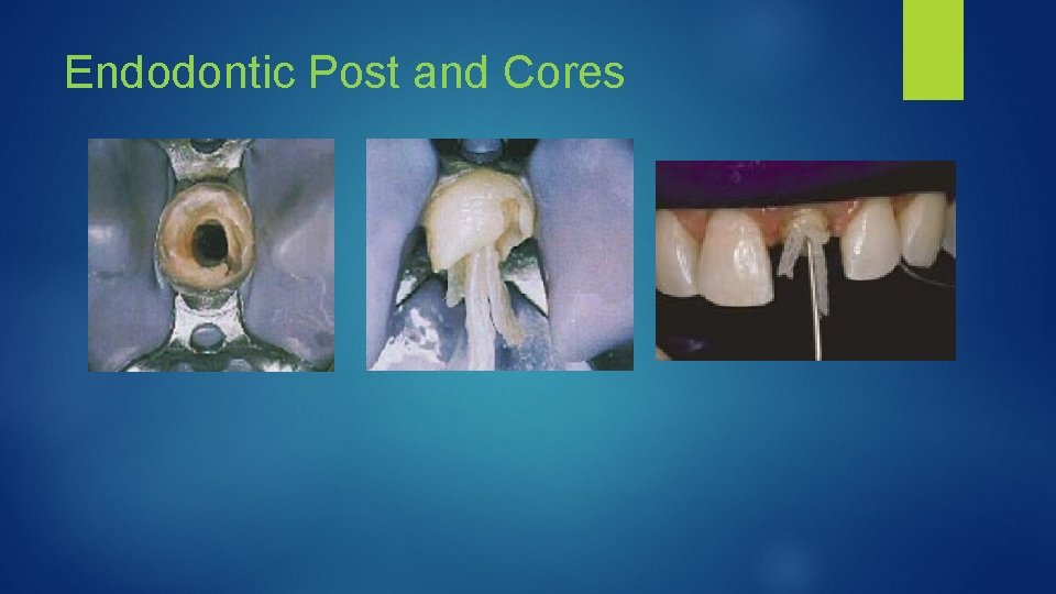 Endodontic Post and Cores 