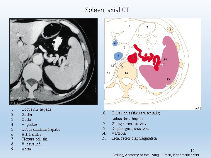 Spleen, axial CT 1. 2. 3. 4. 5. 6. 7. 8. 9. Lobus sin.