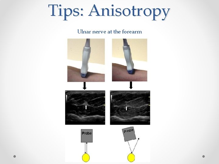 Tips: Anisotropy Ulnar nerve at the forearm 