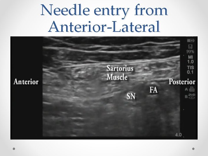 Needle entry from Anterior-Lateral 