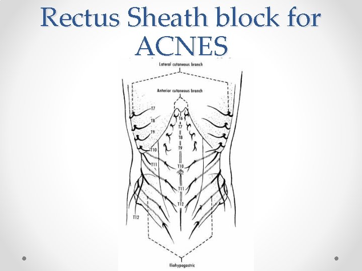 Rectus Sheath block for ACNES 