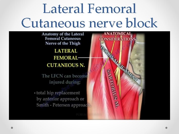 Lateral Femoral Cutaneous nerve block 