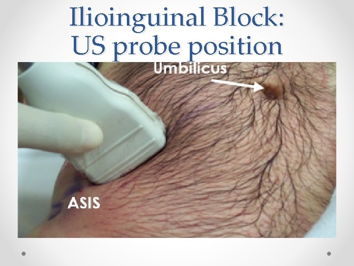 Ilioinguinal Block: US probe position 