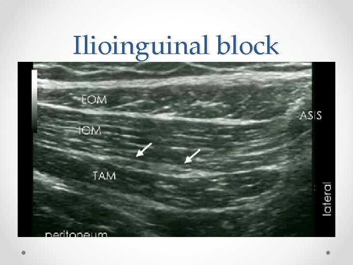 Ilioinguinal block 