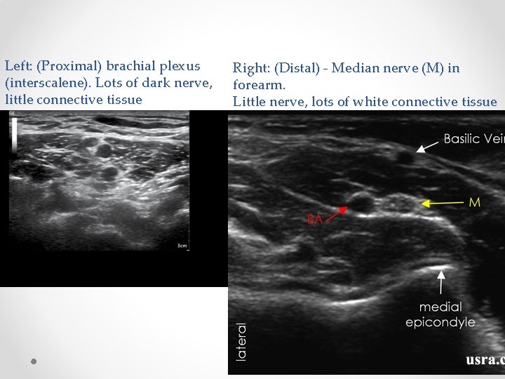 Left: (Proximal) brachial plexus (interscalene). Lots of dark nerve, little connective tissue Right: (Distal)