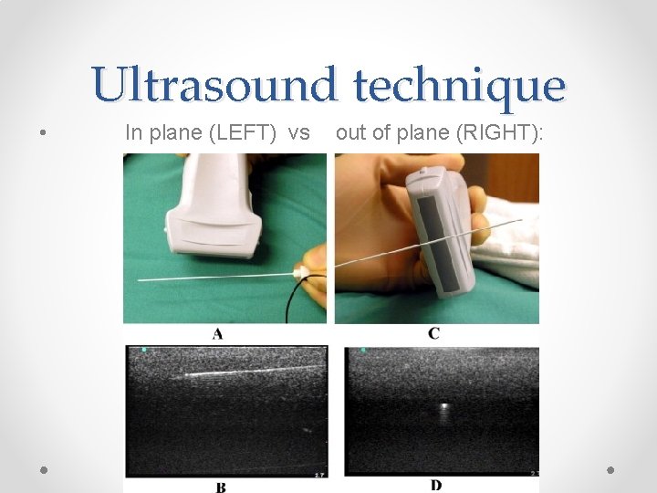 Ultrasound technique • In plane (LEFT) vs out of plane (RIGHT): 