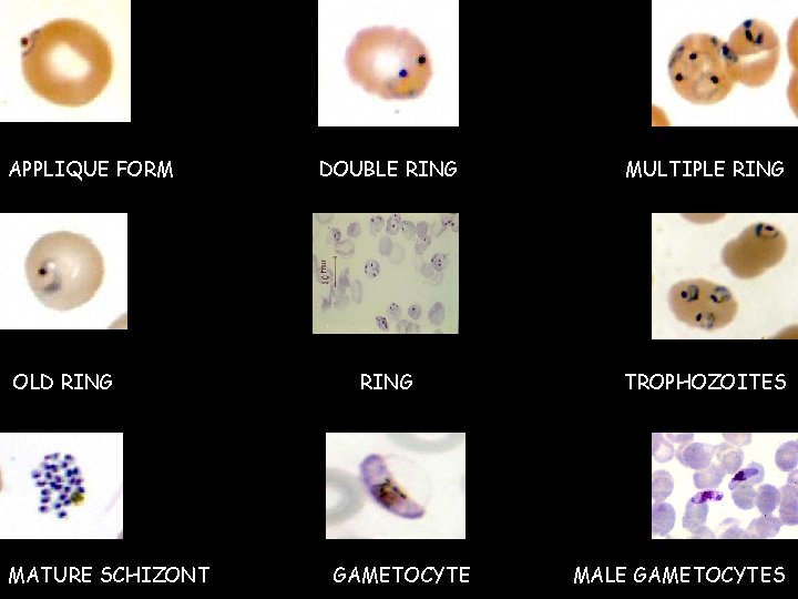 APPLIQUE FORM OLD RING MATURE SCHIZONT DOUBLE RING MULTIPLE RING TROPHOZOITES GAMETOCYTE MALE GAMETOCYTES