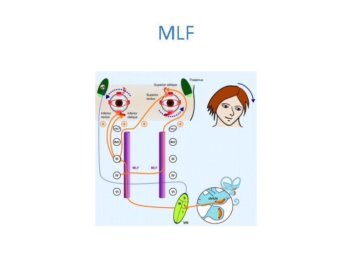 MLF 