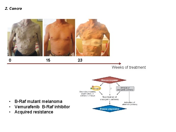 2. Cancro 0 15 23 Weeks of treatment • B-Raf mutant melanoma • Vemurafenib