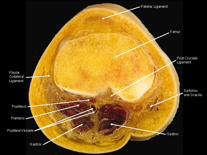 Patellar Ligament Femur Post Cruciate Ligament Fibular Collateral Ligament Sartorius and Gracilis Popliteus Plantaris