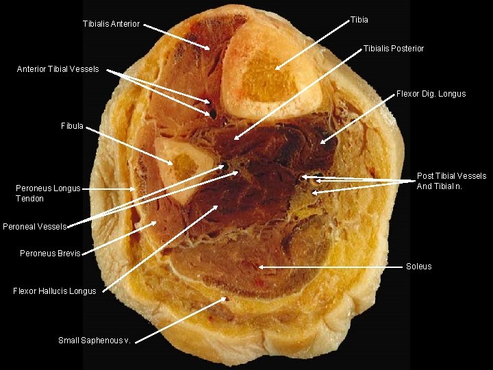 Tibialis Anterior Tibialis Posterior Anterior Tibial Vessels Flexor Dig. Longus Fibula Peroneus Longus Tendon