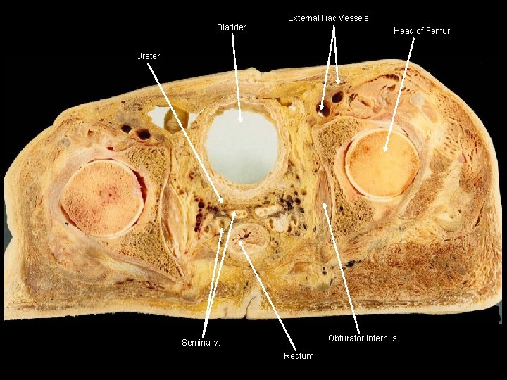 Bladder External Iliac Vessels Head of Femur Ureter Obturator Internus Seminal v. Rectum 