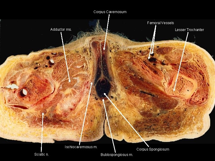 Corpus Cavernosum Femoral Vessels Adductor ms. Lesser Trochanter Ischiocavernosus m. Sciatic n. Corpus Spongiosum