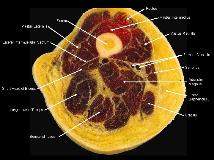 Rectus Femur Vastus Intermedius Vastus Lateralis Vastus Medialis Lateral Intermuscular Septum Femoral Vessels Sartorius