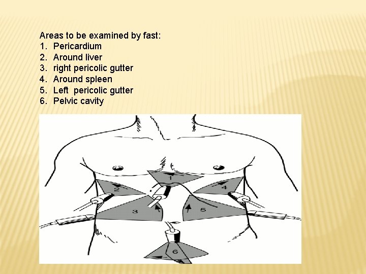 Areas to be examined by fast: 1. Pericardium 2. Around liver 3. right pericolic