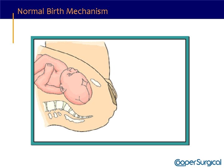 Normal Birth Mechanism 