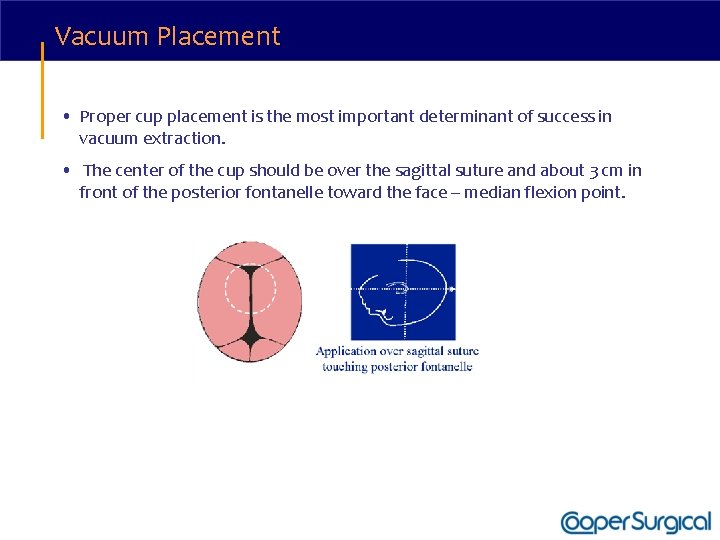 Vacuum Placement • Proper cup placement is the most important determinant of success in