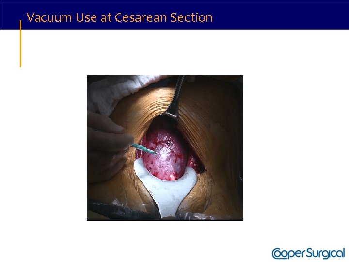 Vacuum Use at Cesarean Section 