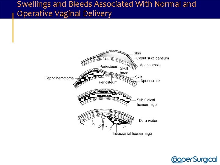 Swellings and Bleeds Associated With Normal and Operative Vaginal Delivery 