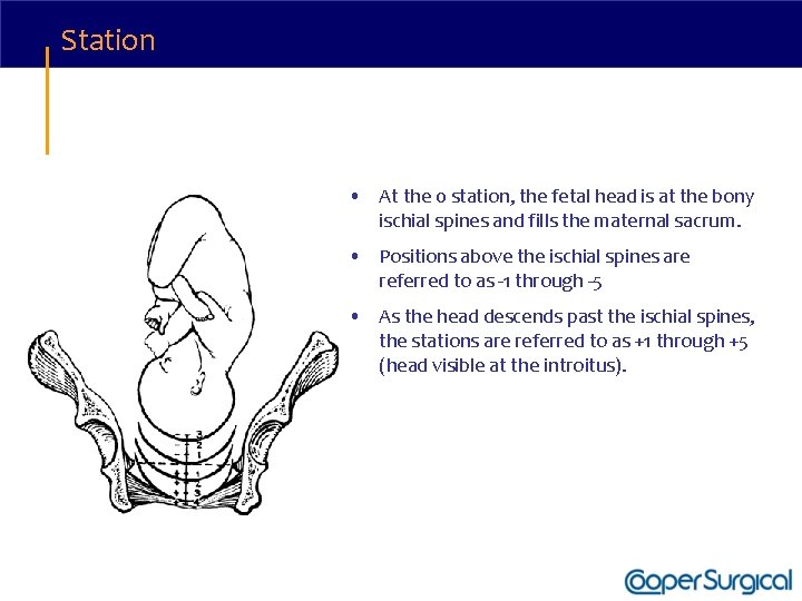 Station • At the 0 station, the fetal head is at the bony ischial