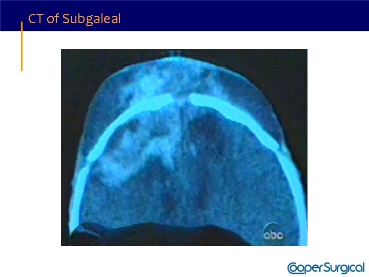 CT of Subgaleal 