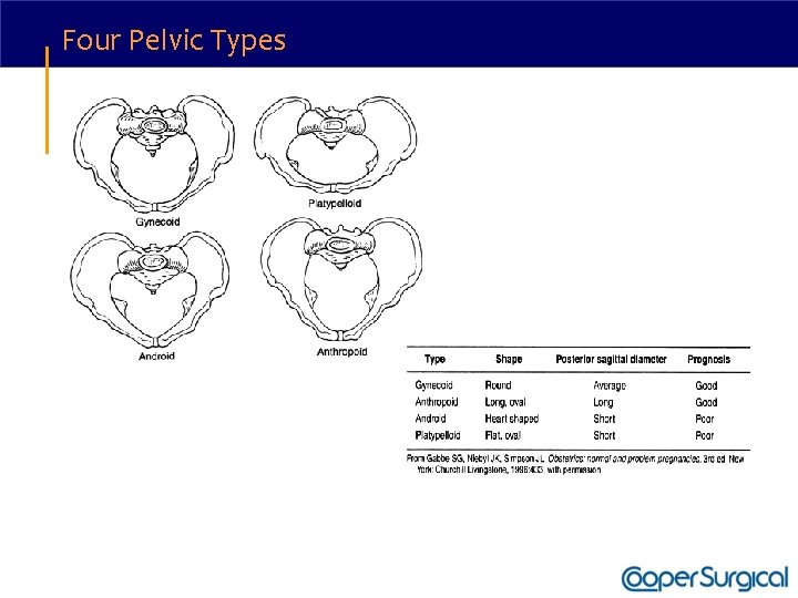 Four Pelvic Types 