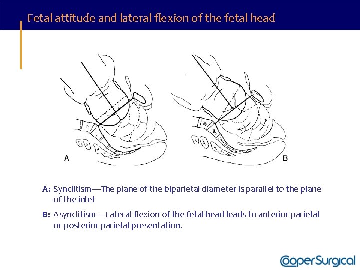 Fetal attitude and lateral flexion of the fetal head A: Synclitism—The plane of the