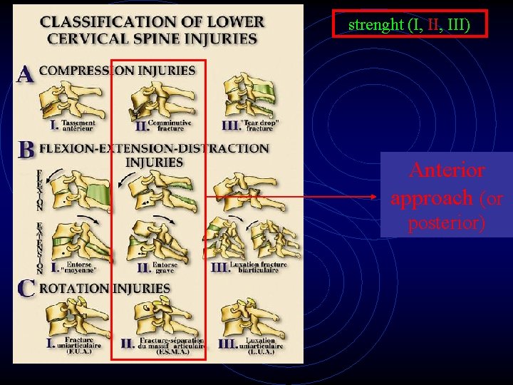 strenght (I, III) Anterior approach (or posterior) 