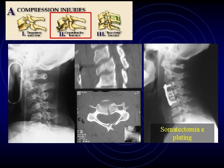Somatectomia e plating 