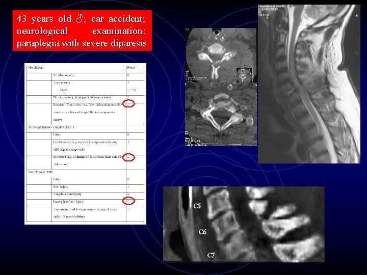 43 years old ♂; car accident; neurological examination: paraplegia with severe diparesis 