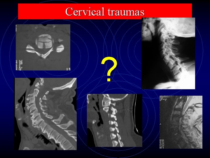 Cervical traumas ? 