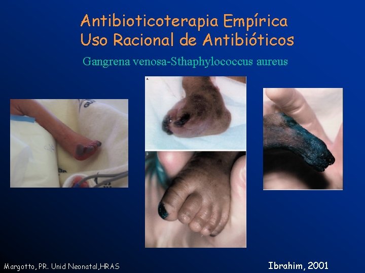 Antibioticoterapia Empírica Uso Racional de Antibióticos Gangrena venosa-Sthaphylococcus aureus Margotto, PR. Unid Neonatal, HRAS