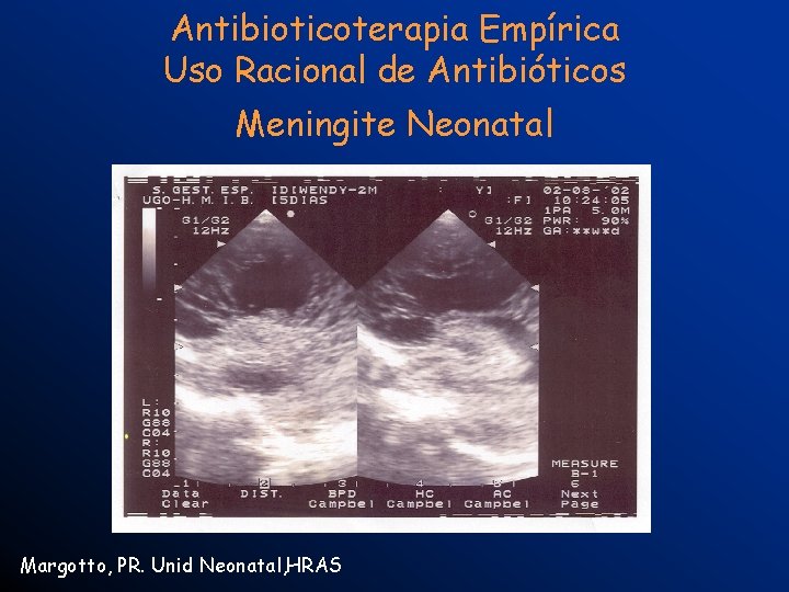 Antibioticoterapia Empírica Uso Racional de Antibióticos Meningite Neonatal Margotto, PR. Unid Neonatal, HRAS 