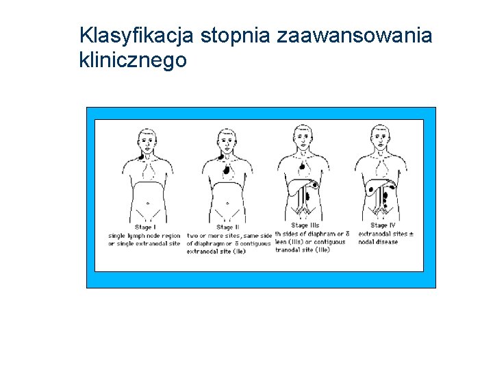 Klasyfikacja stopnia zaawansowania klinicznego 