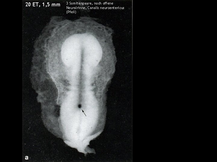 20 ET, 1, 5 mm 3 Somitenpaare, noch offene Neuralrinne, Canalis neuroentericus (Pfeil) 