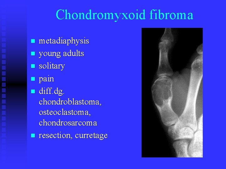 Chondromyxoid fibroma n n n metadiaphysis young adults solitary pain diff. dg. chondroblastoma, osteoclastoma,