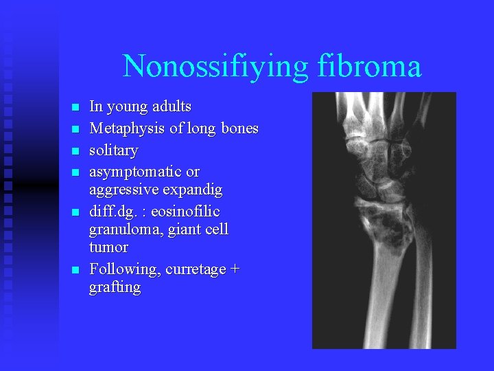 Nonossifiying fibroma n n n In young adults Metaphysis of long bones solitary asymptomatic