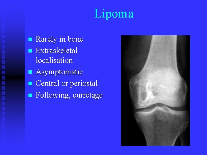 Lipoma n n n Rarely in bone Extraskeletal localisation Asymptomatic Central or periostal Following,