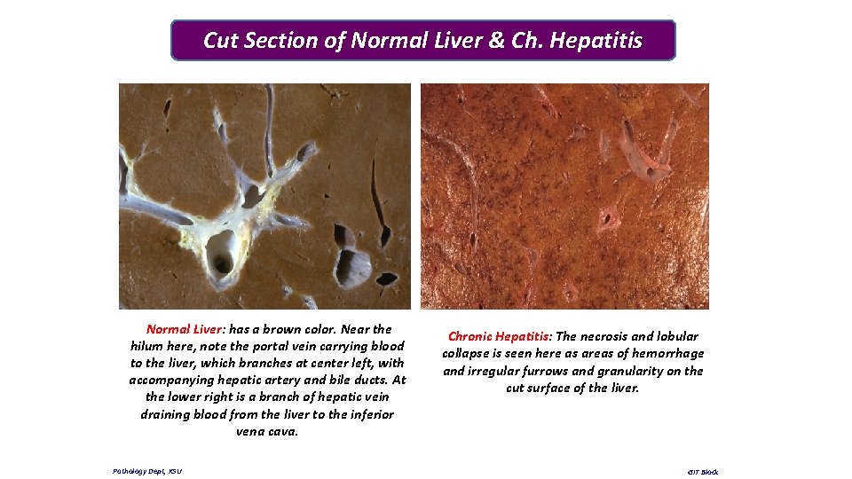 Cut Section of Normal Liver & Ch. Hepatitis Normal Liver: has a brown color.