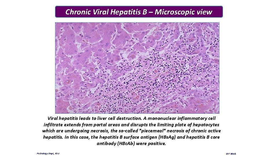 Chronic Viral Hepatitis B – Microscopic view Viral hepatitis leads to liver cell destruction.