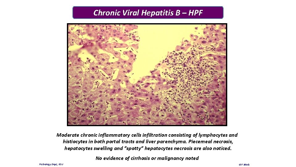 Chronic Viral Hepatitis B – HPF Moderate chronic inflammatory cells infiltration consisting of lymphocytes