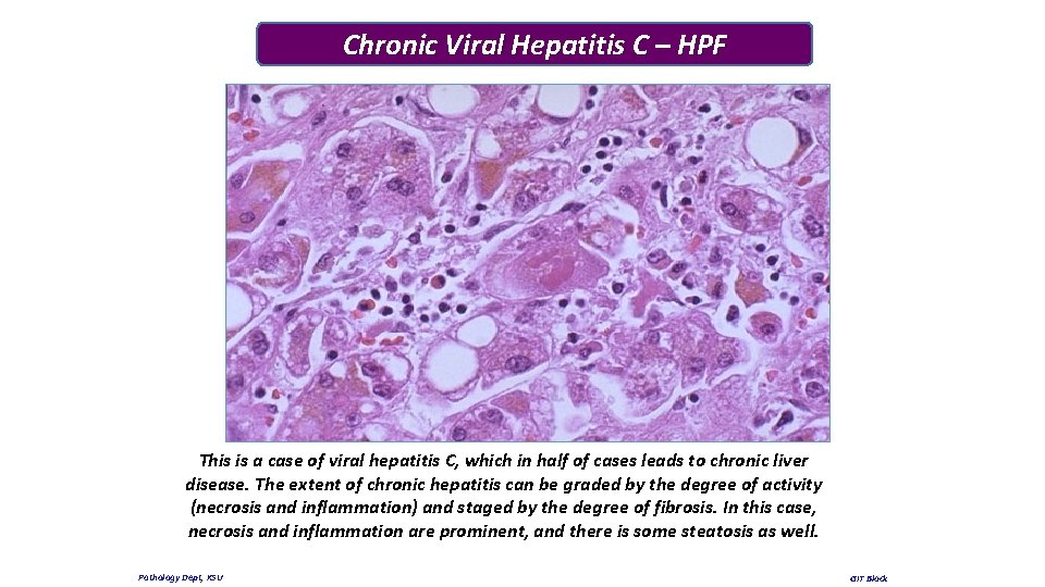 Chronic Viral Hepatitis C – HPF This is a case of viral hepatitis C,