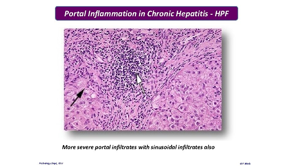 Portal Inflammation in Chronic Hepatitis - HPF More severe portal infiltrates with sinusoidal infiltrates