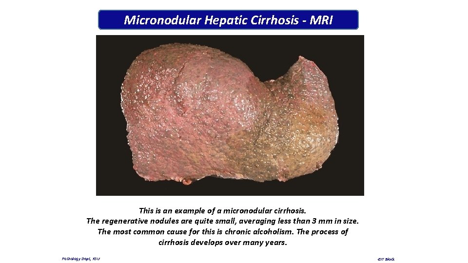 Micronodular Hepatic Cirrhosis - MRI This is an example of a micronodular cirrhosis. The